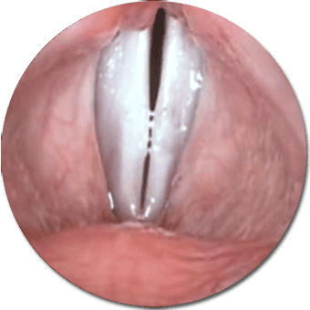 Stroboscopia endoscopica delle corde vocali